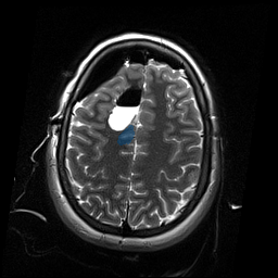 ReMIND-002__2d-ax-t2-blade — ReMIND — Brain tumor multi-modal MR (raw, with iUS) case preview