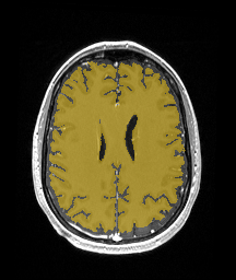 ReMIND-002__3d-ax-t1-postcontrast — ReMIND — Brain tumor multi-modal MR (raw, with iUS) case preview