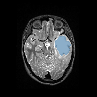 ReMIND — Brain tumor multi-modal MR (raw, with iUS) preview