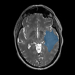 ReMIND-114__3d-ax-t2-space — ReMIND — Brain tumor multi-modal MR (raw, with iUS) case preview