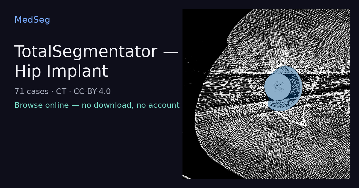 TotalSegmentator — Hip Implant — example case rendered in the MedSeg editor