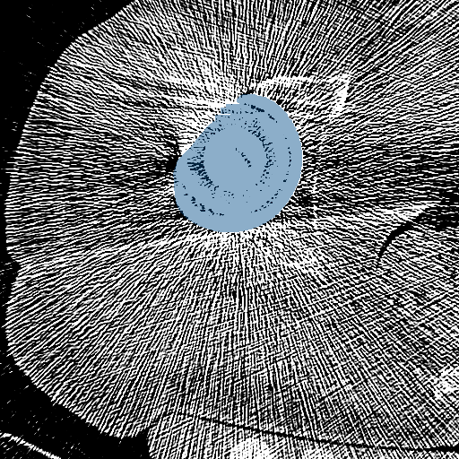 3gmXcSq12lqKtAkS — TotalSegmentator — Hip Implant case preview