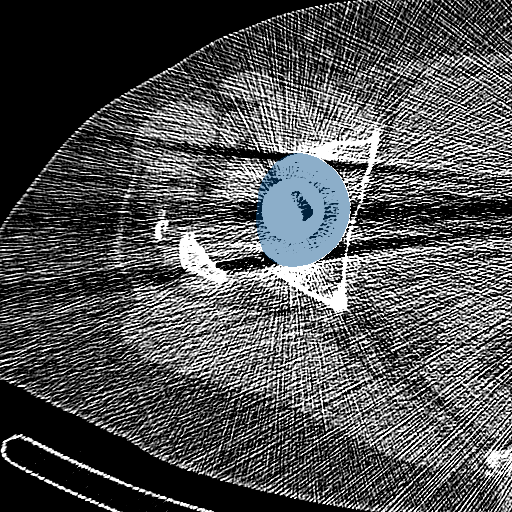 67dYZaq6hSbQszWc — TotalSegmentator — Hip Implant case preview