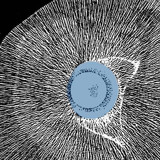 EfVSd2gHagvkCyD0 — TotalSegmentator — Hip Implant case preview