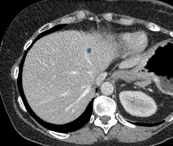 028SIOERaSsC88qg — TotalSegmentator — Liver Lesions (mixed MR + CT) case preview