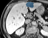 0BJc4QeljgijtV18 — TotalSegmentator — Liver Lesions (mixed MR + CT) case preview