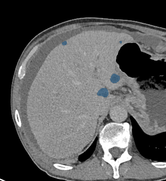 0LdaHSWA3EHk8VVe — TotalSegmentator — Liver Lesions (mixed MR + CT) case preview