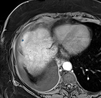 0T5z5N7BsISCX6Dn — TotalSegmentator — Liver Lesions (mixed MR + CT) case preview