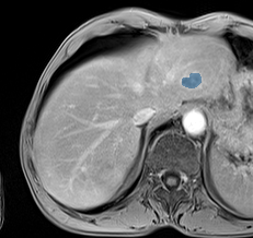 TotalSegmentator — Liver Lesions (mixed MR + CT) preview
