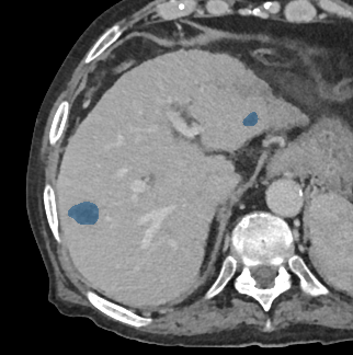 vuPw782Wez5chyd4 — TotalSegmentator — Liver Lesions (mixed MR + CT) case preview