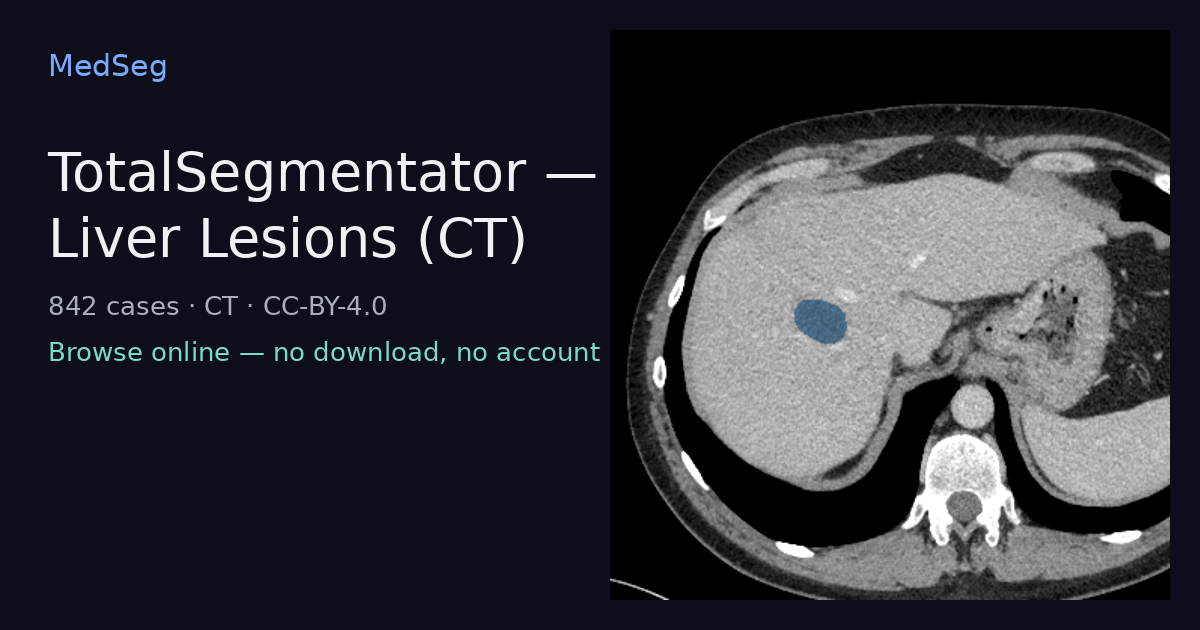 TotalSegmentator — Liver Lesions (CT) — example case rendered in the MedSeg editor