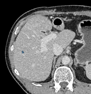038lIVt2WjmwWJc6 — TotalSegmentator — Liver Lesions (CT) case preview