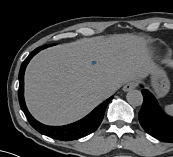 0AbJHdnCKYU14XnY — TotalSegmentator — Liver Lesions (CT) case preview