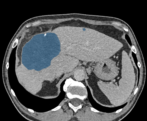 0LHth9cfqxoisxhI — TotalSegmentator — Liver Lesions (CT) case preview