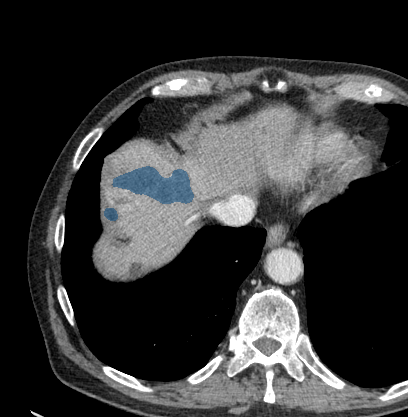 0R65xRVtCrSfrJQC — TotalSegmentator — Liver Lesions (CT) case preview