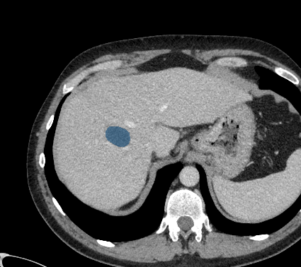 TotalSegmentator — Liver Lesions (CT) preview