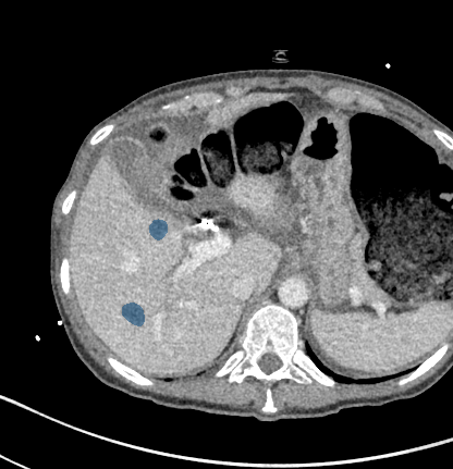 LIXccrDJ5ADyoANq — TotalSegmentator — Liver Lesions (CT) case preview
