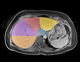1TXdtAw1x4e9dHvl — TotalSegmentator — Liver Couinaud Segments (MR) case preview