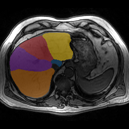 1oqsYgz8VneMqTBF — TotalSegmentator — Liver Couinaud Segments (MR) case preview