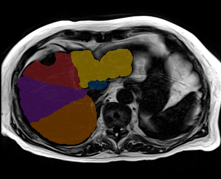 3kz5yIBfcwwl7sLm — TotalSegmentator — Liver Couinaud Segments (MR) case preview