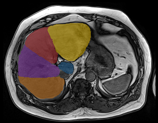 4fBAadbkrWlohMl5 — TotalSegmentator — Liver Couinaud Segments (MR) case preview
