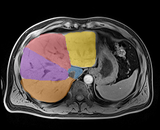 YIMSjo3ZL9jfEIsC — TotalSegmentator — Liver Couinaud Segments (MR) case preview