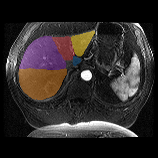 TotalSegmentator — Liver Couinaud Segments (MR) preview