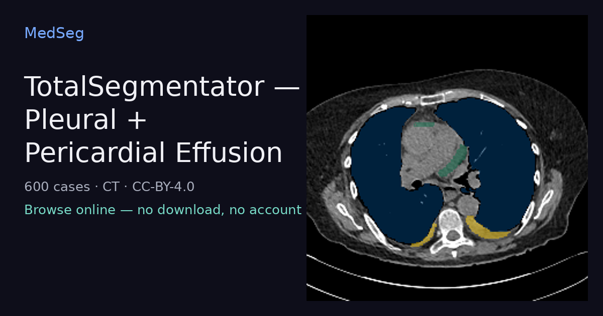 TotalSegmentator — Pleural + Pericardial Effusion — example case rendered in the MedSeg editor