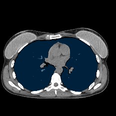 01FrbE7fAKGO3mAB — TotalSegmentator — Pleural + Pericardial Effusion case preview
