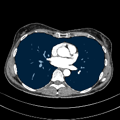 0EPSJmxG8uBYUBZ2 — TotalSegmentator — Pleural + Pericardial Effusion case preview