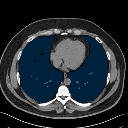 0dyMlgM3ppdGrBNv — TotalSegmentator — Pleural + Pericardial Effusion case preview