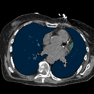 10Pnlj0oXaiJgZKe — TotalSegmentator — Pleural + Pericardial Effusion case preview