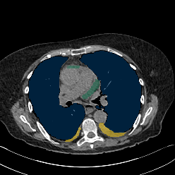 8ITmAVO1fzqcKTDm — TotalSegmentator — Pleural + Pericardial Effusion case preview