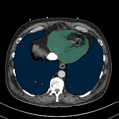 Nv4mlOmqzCnM7arg — TotalSegmentator — Pleural + Pericardial Effusion case preview