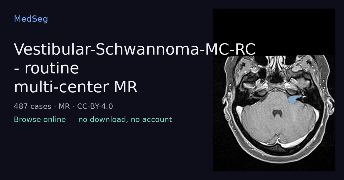 Vestibular-Schwannoma-MC-RC - routine multi-center MR — example case rendered in the MedSeg editor