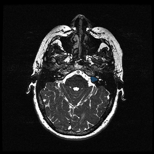 VS-MC-RC-002__1987-03-07__s5__t2-ax-3d-fiesta — Vestibular-Schwannoma-MC-RC - routine multi-center MR case preview