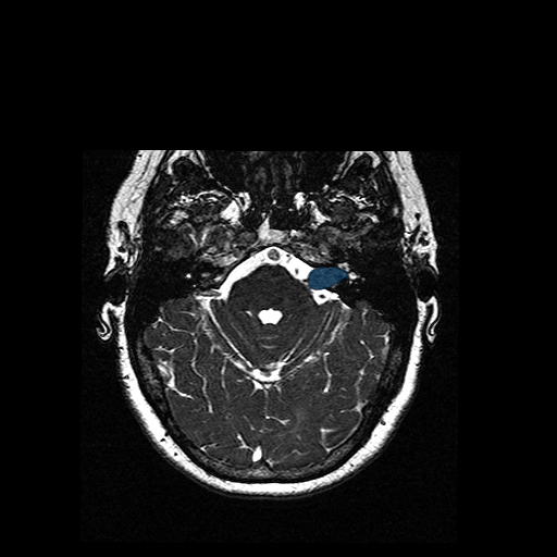 VS-MC-RC-002__1988-10-29__s3__t2-ax-3d-fiesta — Vestibular-Schwannoma-MC-RC - routine multi-center MR case preview
