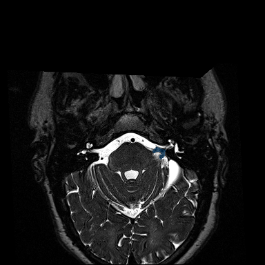 VS-MC-RC-004__1996-11-05__s5__t2-t2-spc-tra-iso — Vestibular-Schwannoma-MC-RC - routine multi-center MR case preview