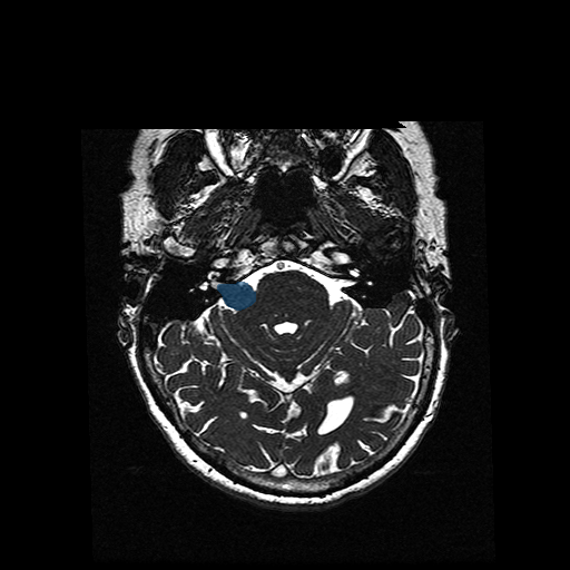 VS-MC-RC-005__1988-09-04__s4__t2-ax-3d-fiesta — Vestibular-Schwannoma-MC-RC - routine multi-center MR case preview