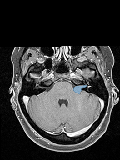 Vestibular-Schwannoma-MC-RC - routine multi-center MR preview