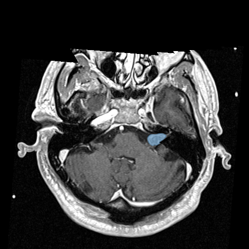 VS-SEG-221__1998-06-23__s2__t1-t1-fl3d-tra-gk-v1 — Vestibular-Schwannoma-MC-RC - routine multi-center MR case preview